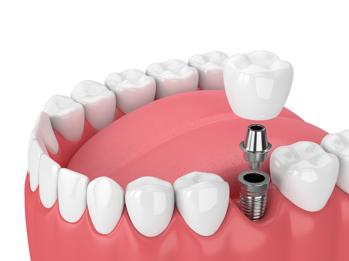 The Silent Threat: Why Gum Disease Should Never Be Ignored